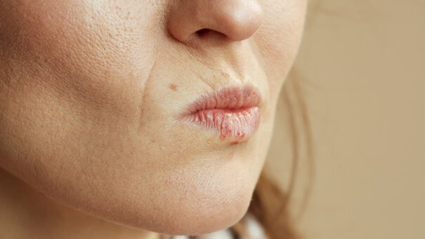 Damaged woman lips