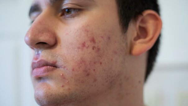Dry skin in winter